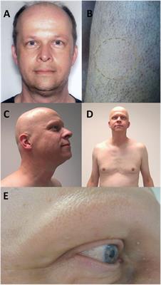 Alopecia Universalis following Alemtuzumab Treatment in Multiple Sclerosis: A Barely Recognized Manifestation of Secondary Autoimmunity—Report of a Case and Review of the Literature